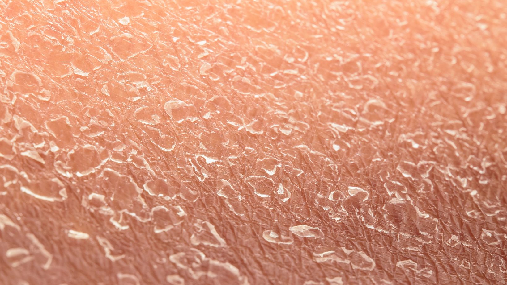 Suchá a šupinatá pokožka – obnova a kompletný návod, ako ju dať do poriadku, slovenska prirodna kozmetika, obnova koznej bariery